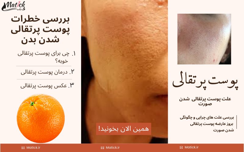 پوست پرتقالی، راه های مبارزه و پیشگیری در مقابل پرتقالی شدن پوست صورت و بدن